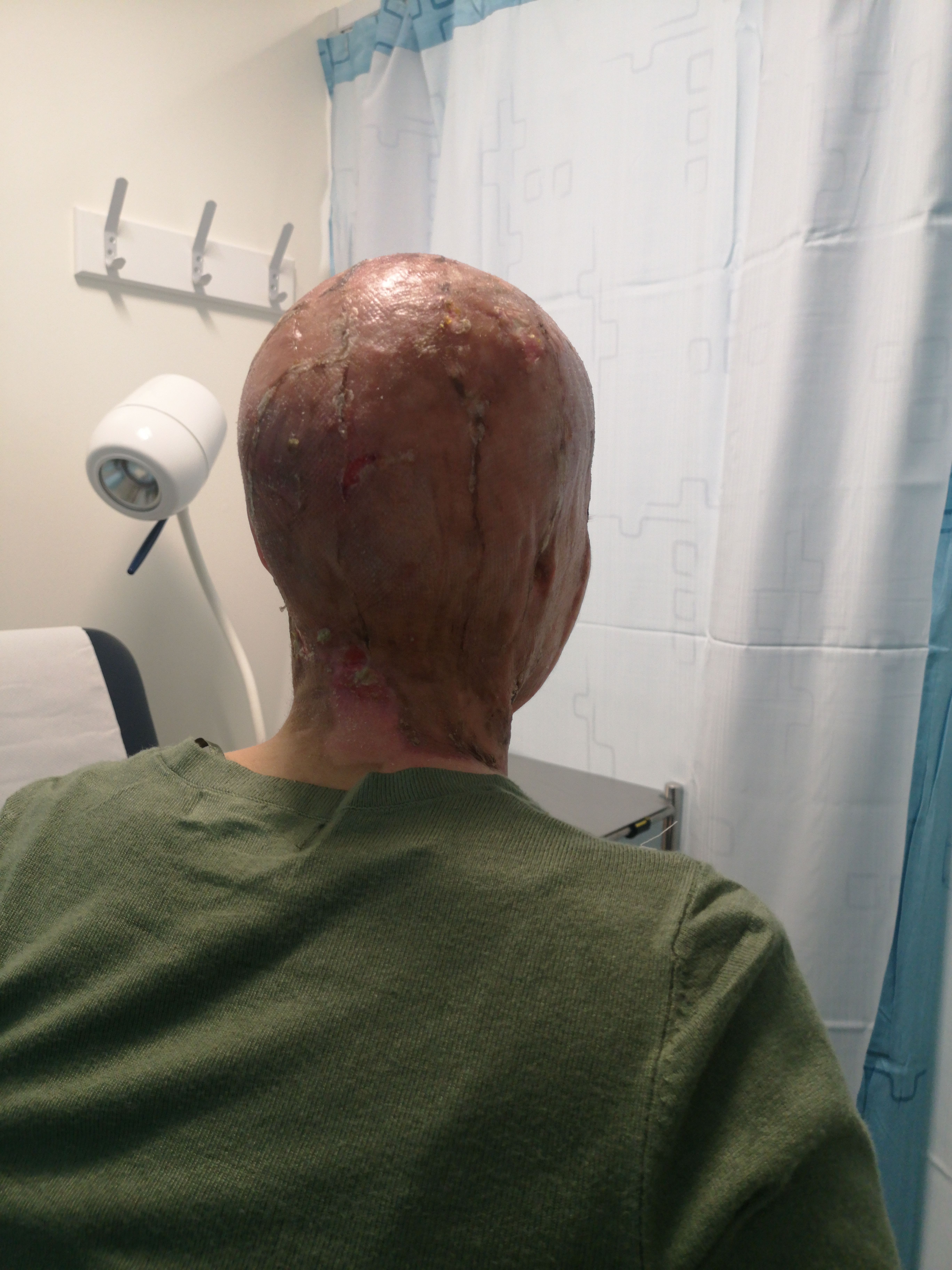 Anna Milosevic, 25, feared she was about to die when she felt her skin being forcibly removed from her head.