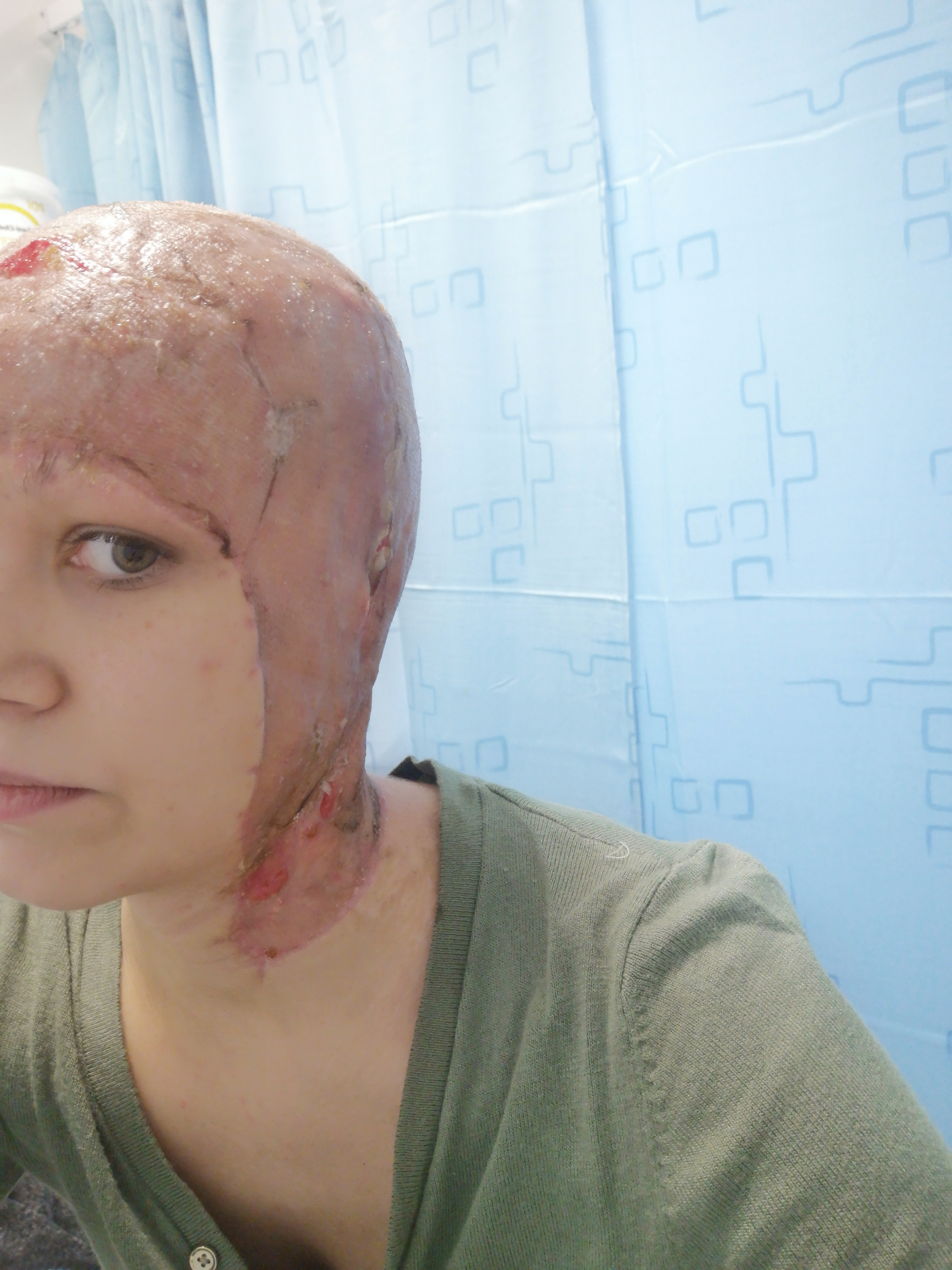 Anna's skin was pulled from her head. "Like tearing a tape" After getting her hair tangled in the drill.